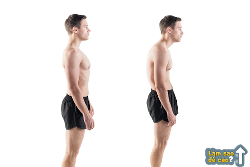 Đứng khom lưng về phía trước không tốt cho hệ xương và chiều cao
