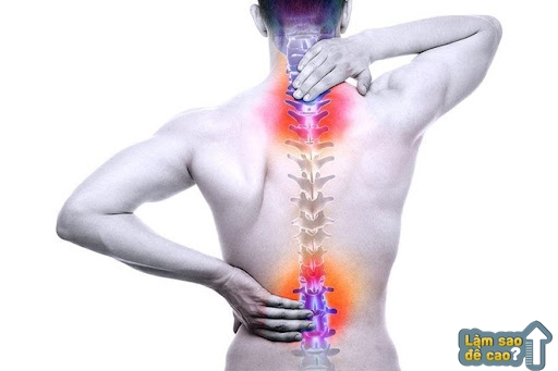 Gù lưng gây ra những cơn đau nhức